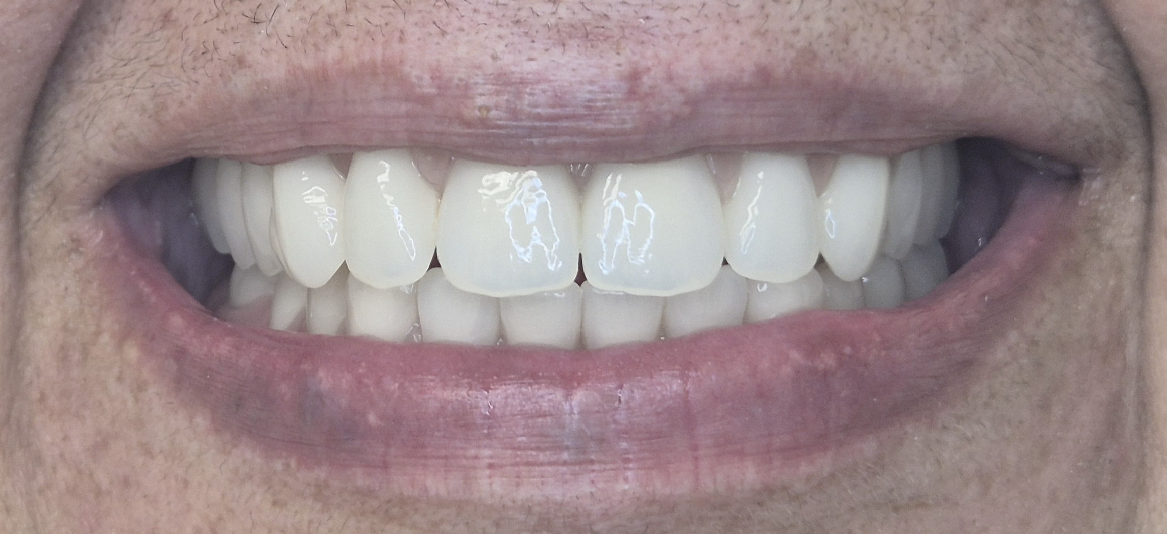 Después del tratamiento - Caso 1