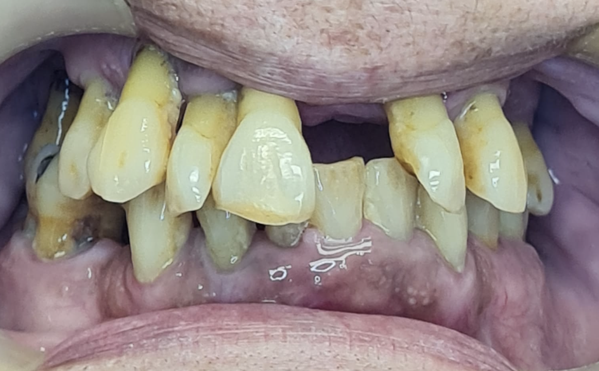 Antes del tratamiento - Caso 1