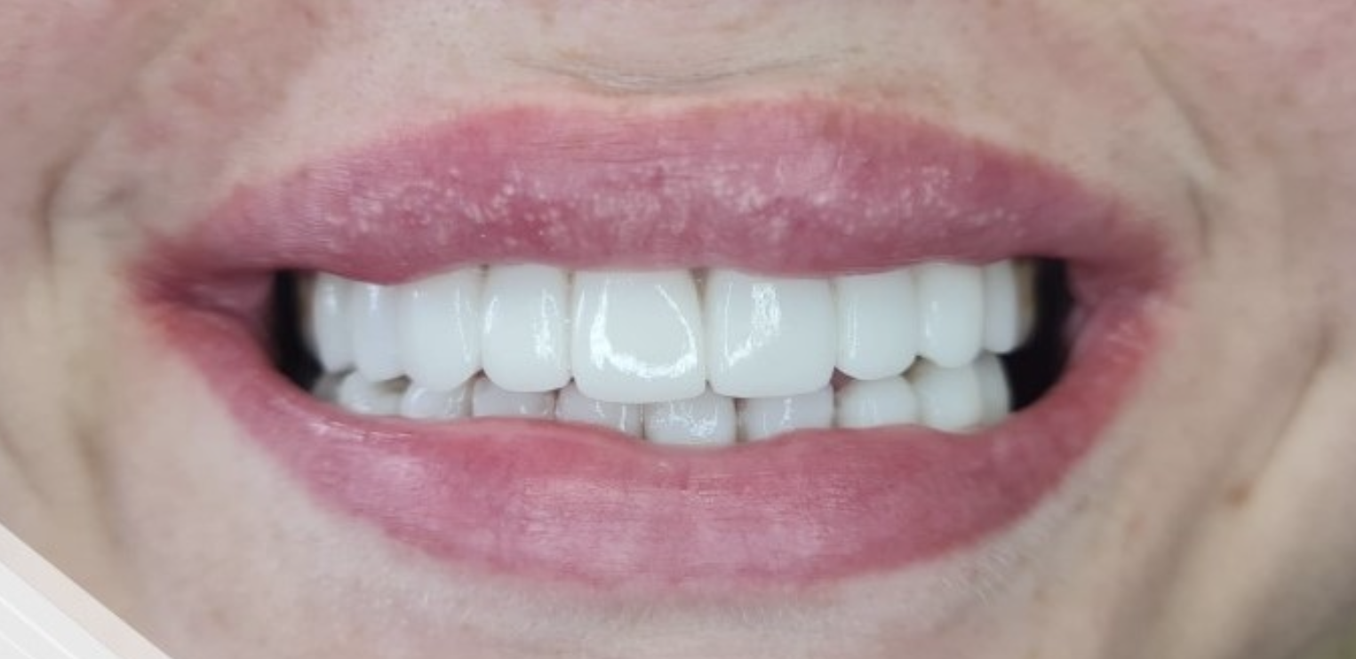 Después del tratamiento - Caso 2