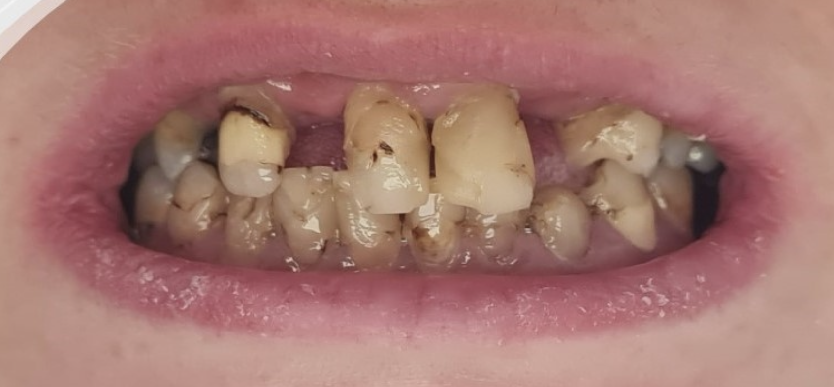 Antes del tratamiento - Caso 2